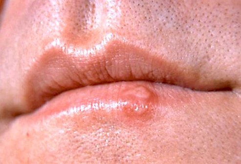 Cold sores last 7-10 days; they're contagious until completely crusted over.