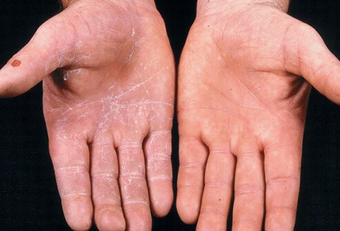 Ringworm of the hand (tinea manus)