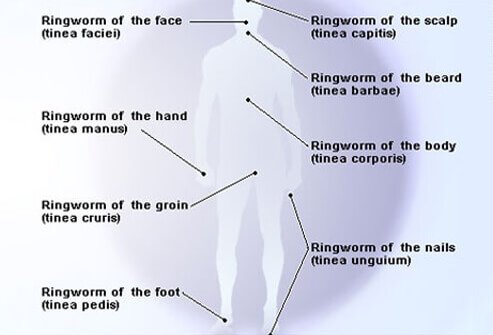 Multiple forms of ringworm affect different parts of the body.