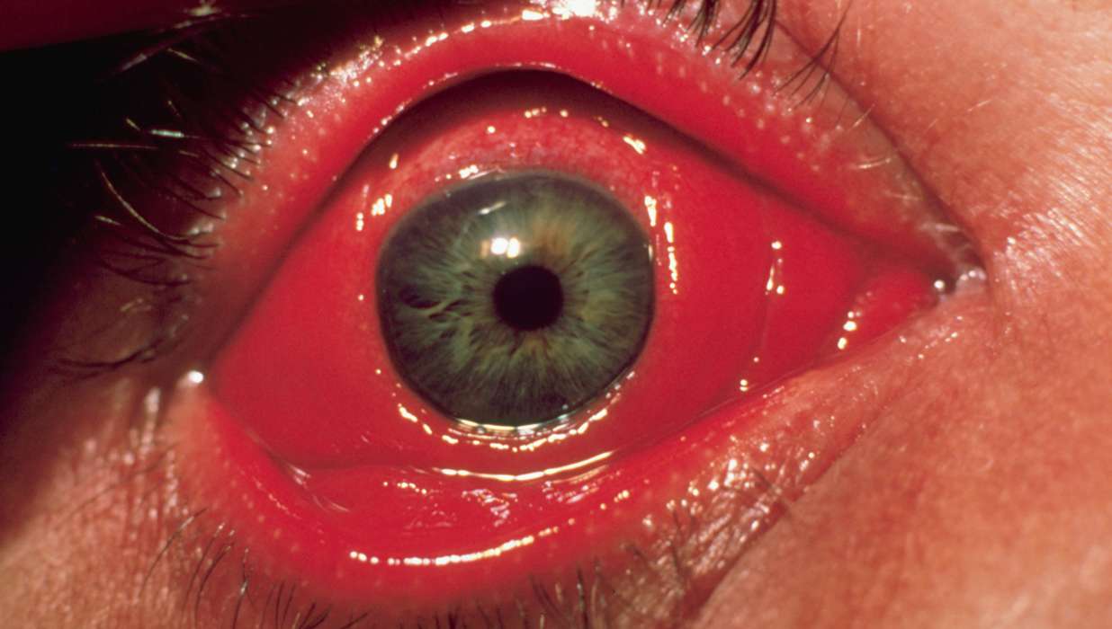 Image result for Disease